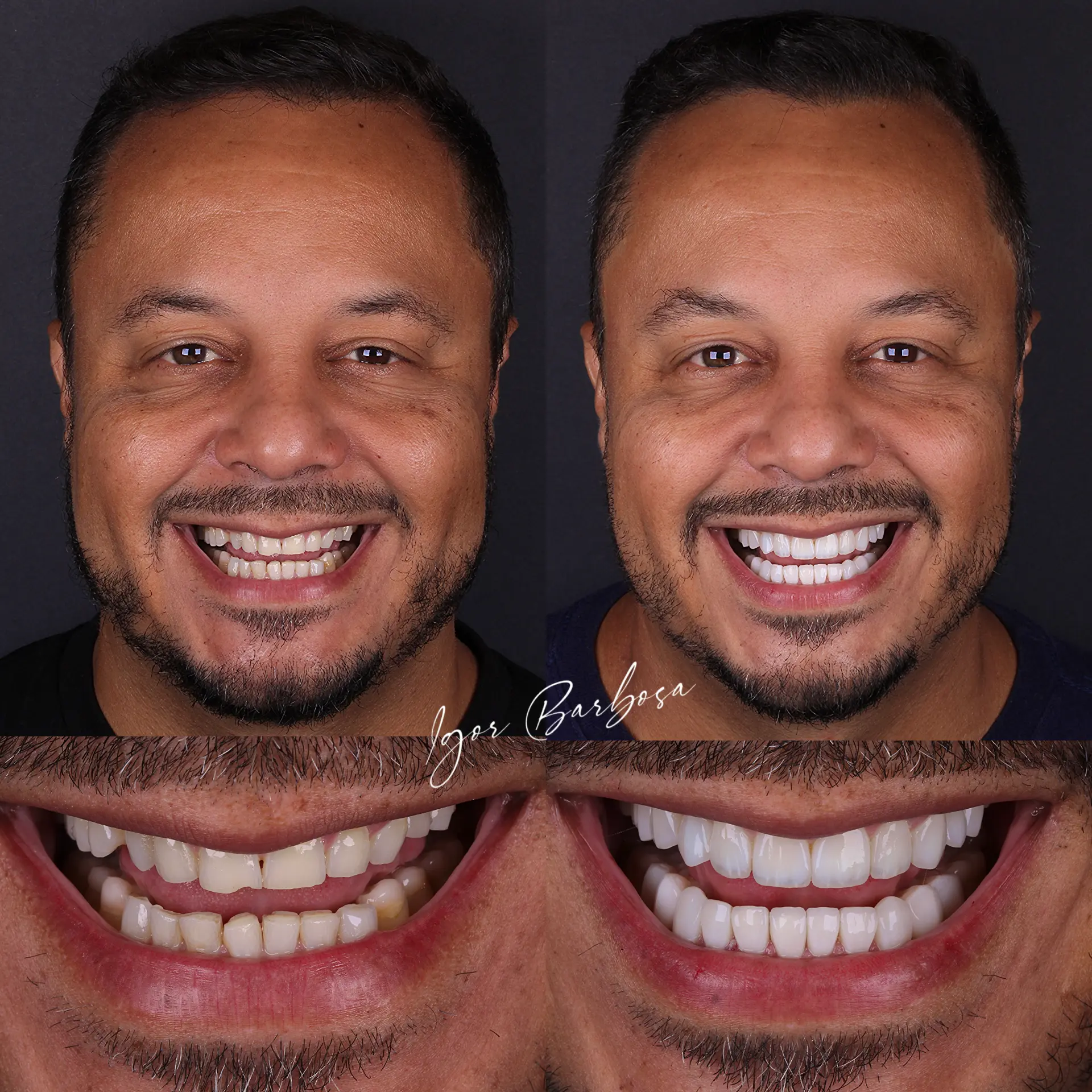 Caso real - lentes em resina Dr. Igor Barbosa
