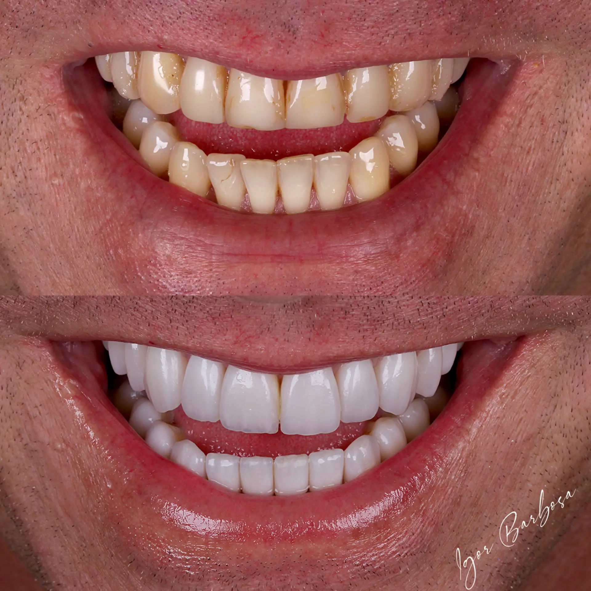 Caso real - lentes em resina Dr. Igor Barbosa