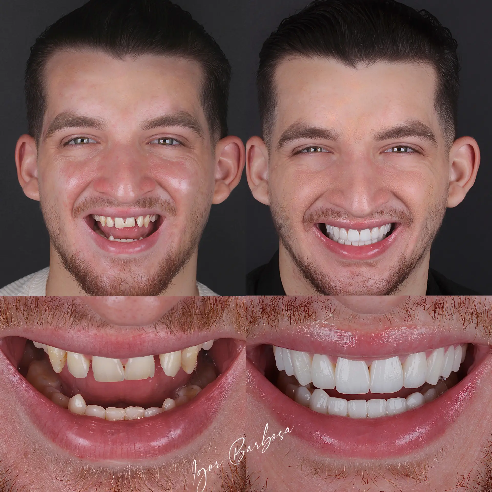 Caso real - lentes em resina Dr. Igor Barbosa