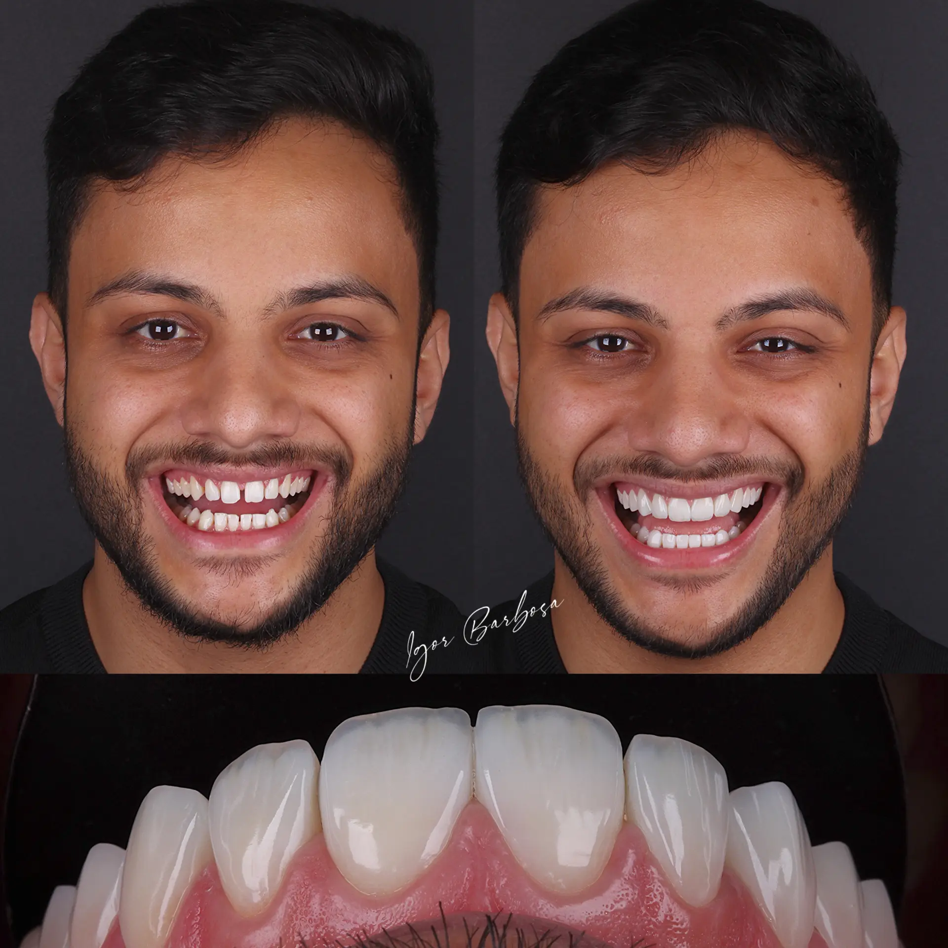 Caso real - lentes em resina Dr. Igor Barbosa
