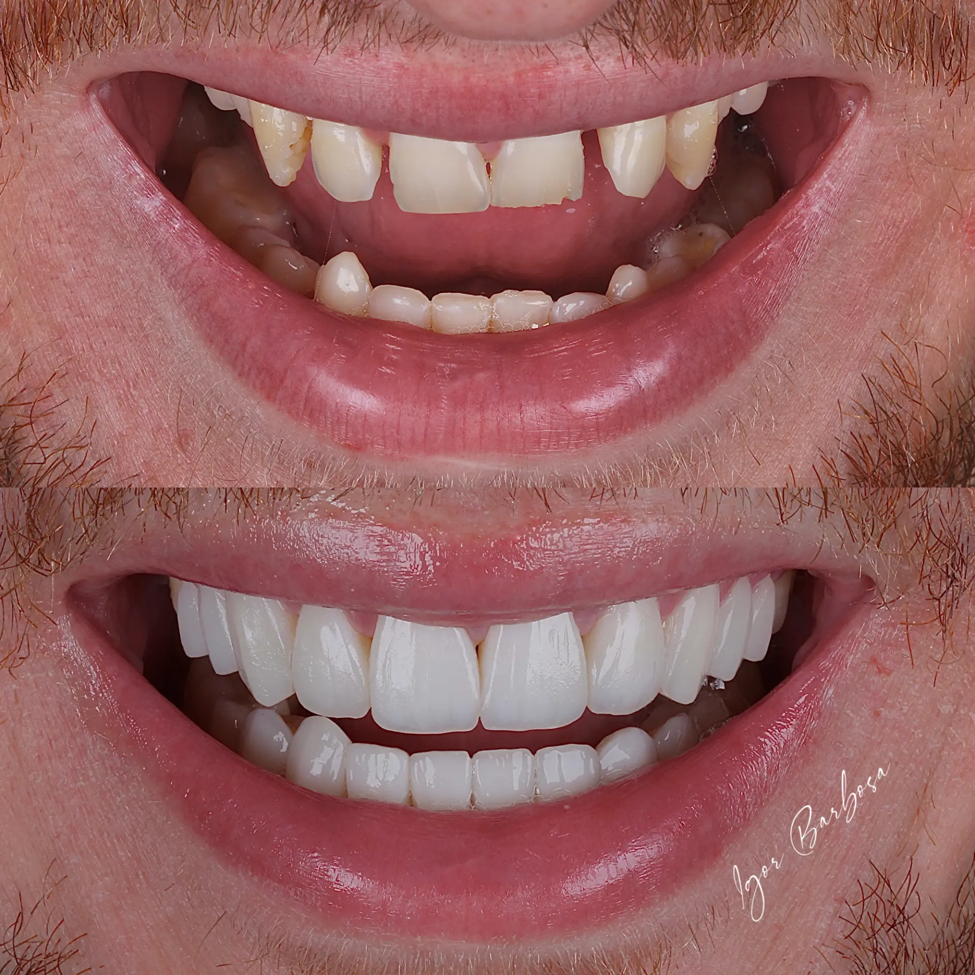 Caso real - lentes em resina Dr. Igor Barbosa