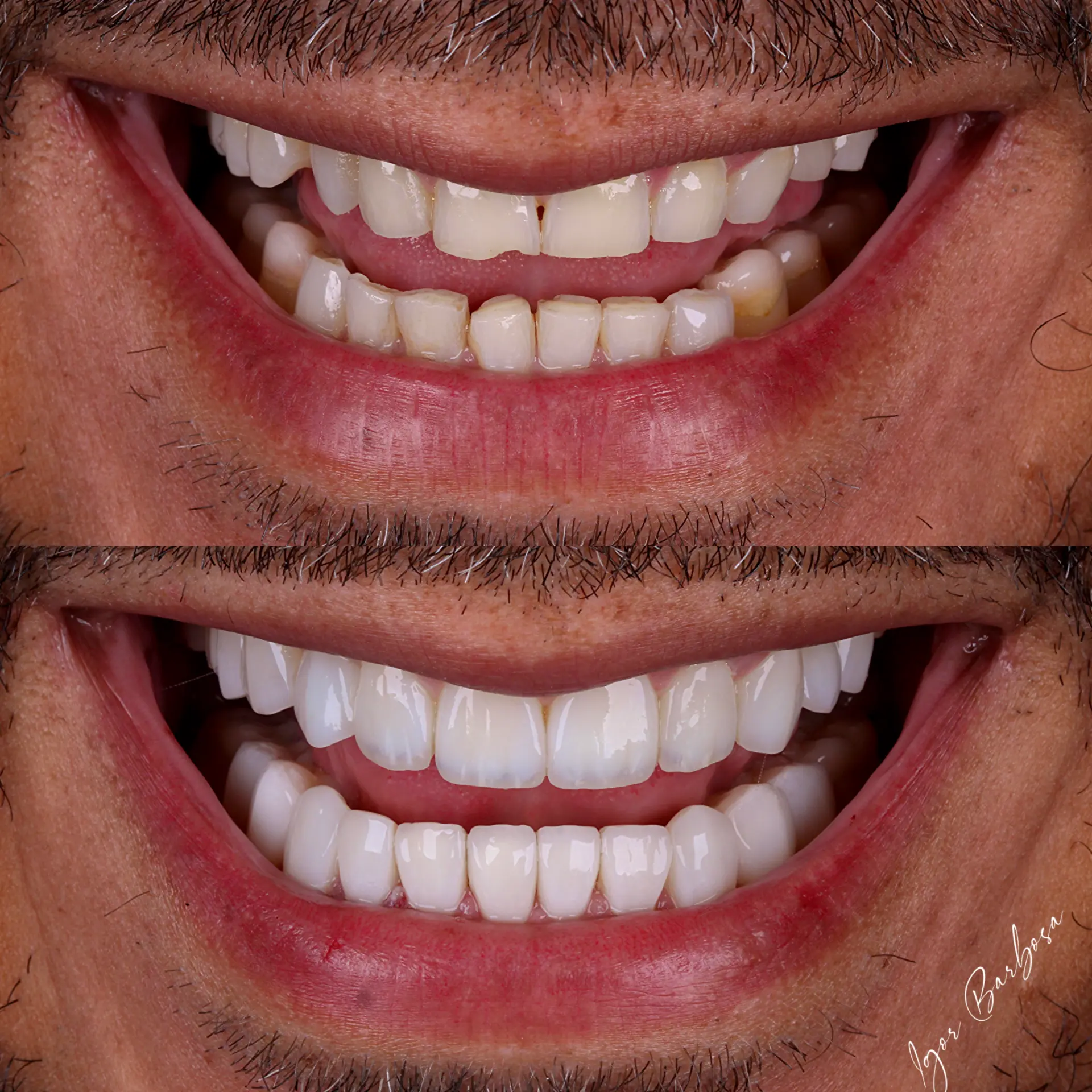 Caso real - lentes em resina Dr. Igor Barbosa