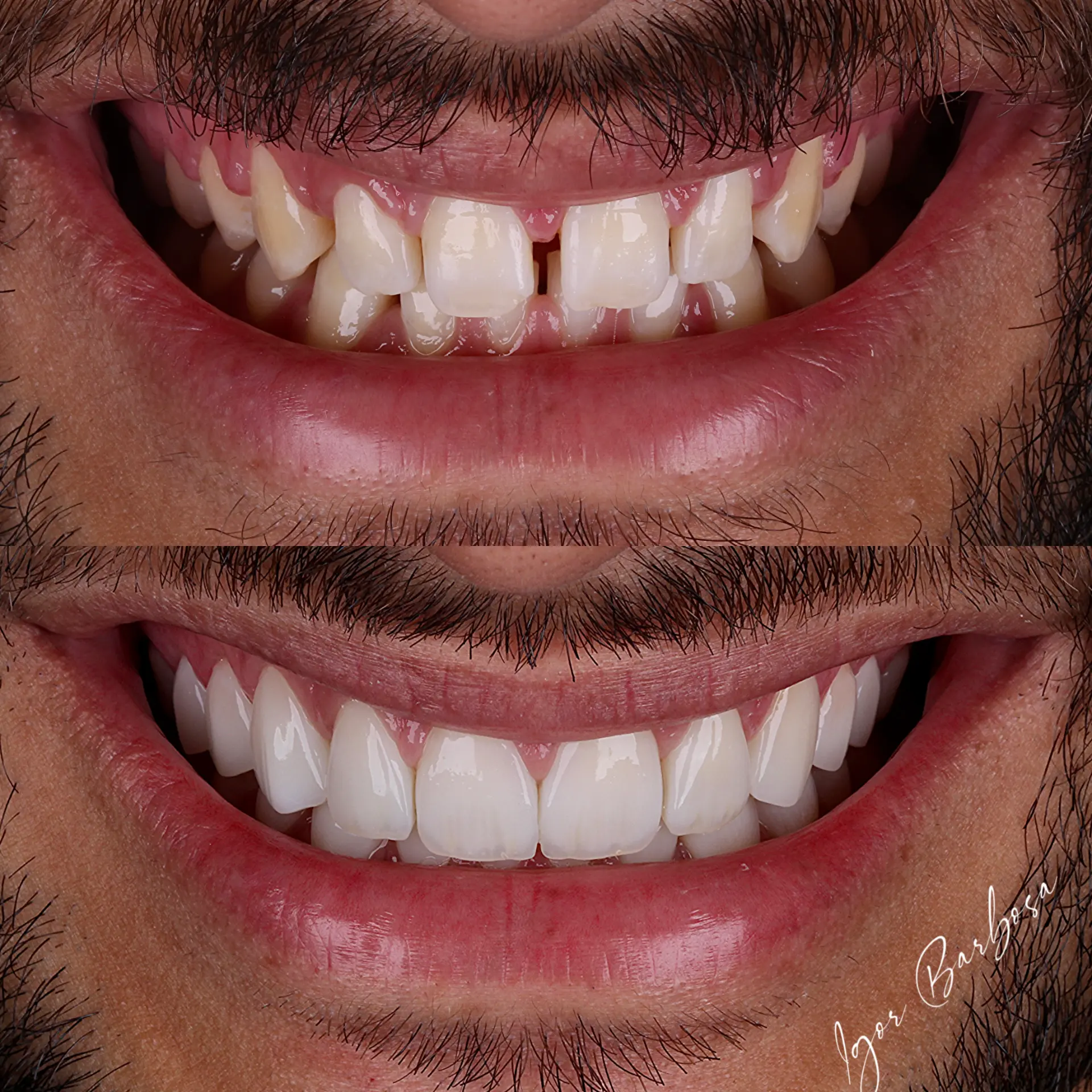 Caso real - lentes em resina Dr. Igor Barbosa